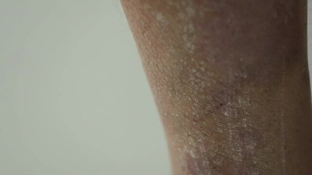Psoriasis. The area of the lower leg affected by psoriatic plaques, rashes and wounds