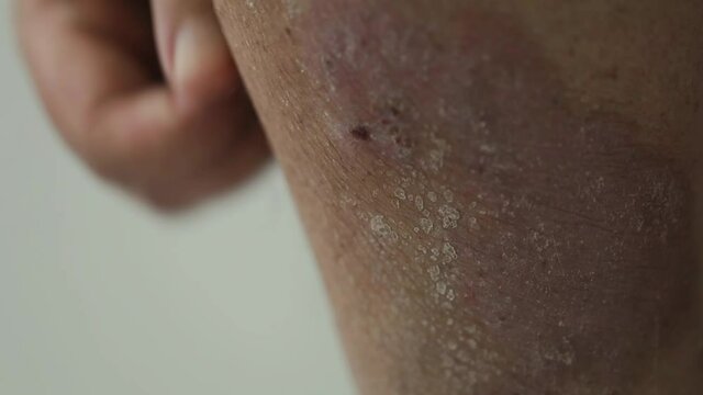 Psoriasis. A man combs the area of the lower leg affected by psoriatic plaques, rashes and wounds. Close up.
