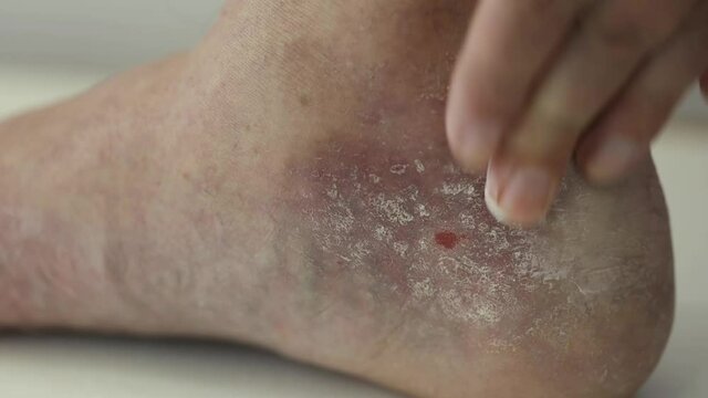 Psoriasis. The man rubs the ointment into the affected part of the foot with psoriatic plaques, rashes and wounds. Close up.