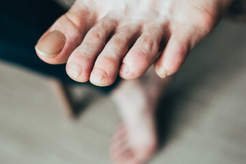 dirty broken groomed weak nails on the male foot - damage and cracking on the nails
