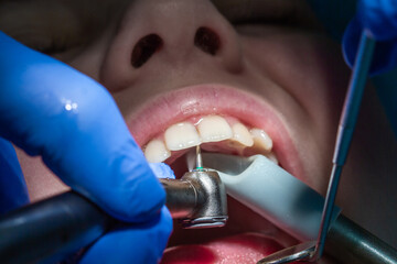 Inspection and treatment of front teeth at the dentist, a drill drills the patient's caries, shot...