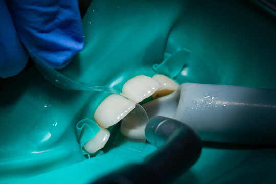Inspection and treatment of anterior teeth at the dentist, cofferdam is put on the incisors, taken in close-up, white clean teeth.

