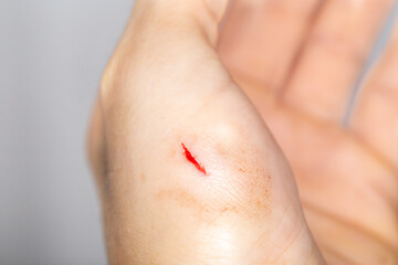 Accidental knife cut in the thumb of a young man during working in the kitchen