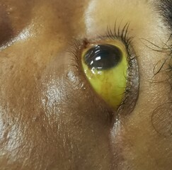 close up of eye with Jaundice