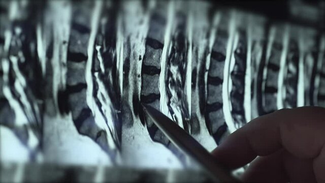 Doctor examines MRI of lumbar spine with pinched discs of spine and nerves, points at problem areas by pen, close-up