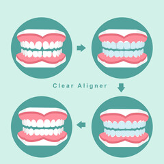 clear aligner