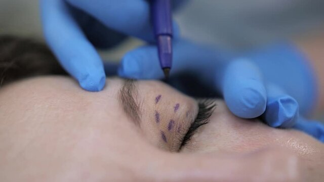 Blepharoplasty, a surgeon makes marker marks on the eyelids for further surgery.