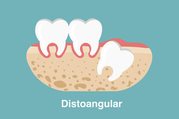 Wisdom tooth ( distoangular impaction ) illustration Vector.