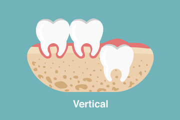 Wisdom tooth ( Vertical impaction ) illustration Vector.