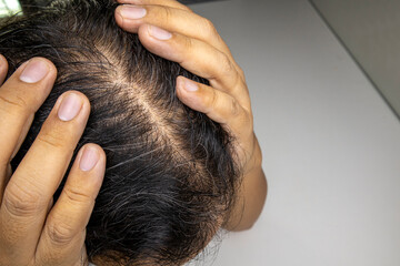 A man with both hands on his head There is stress about hair loss problems.