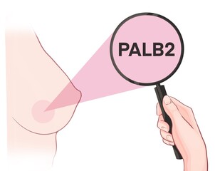Variants in the PALB2 gene are associated with an increased risk of developing breast cancer