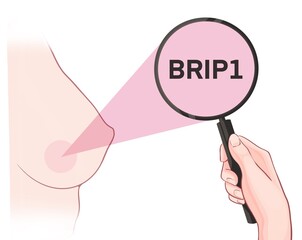 Variants in the BRIP1 gene are associated with an increased risk of developing breast cancer