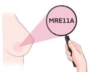 Variants in the MRE11A gene are associated with an increased risk of developing breast cancer