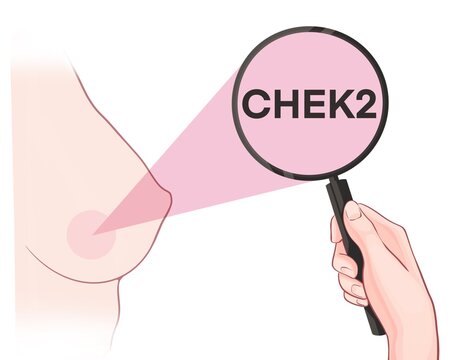 Variants in the CHEK2 gene are associated with an increased risk of developing breast cancer