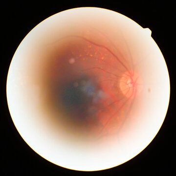 Retinal