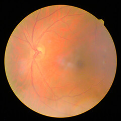 retinal