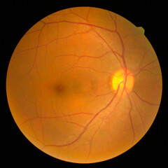 retinal