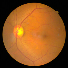 retinal