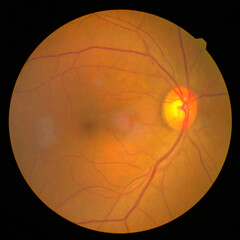 retinal