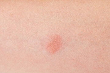 Closeup view photography of caucasian kid's arm with red spot reaction to conducting Mantoux test after 72 hours from injection.