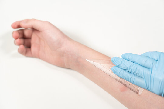 Closeup view photography of child arm with red spot reaction to conducting Mantoux test after 72 hours from injection. Nurse in blue gloves checks reaction using transparent ruler.