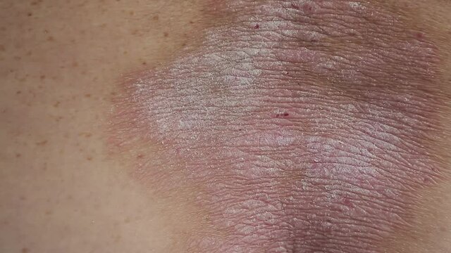 psoriasis: the area of the skin of the back of a person affected by psoriasis wounds plaques rashes
