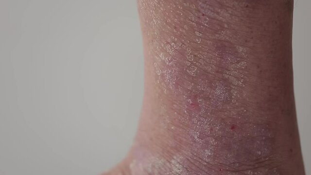 Psoriasis. A man combs the area of the lower leg affected by psoriatic plaques, rashes and wounds. Close up.