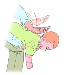 Maniobra de Heimlich en niños - Primeros auxilios