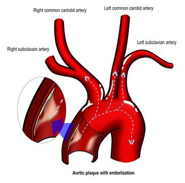 Aortic Atherosclerosis And Arotic Plaque Embolization Are One Of The Courses Of Cerebral Embolization And Ischemic Stroke. 