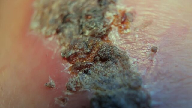 A macro shot of a scab on a knee