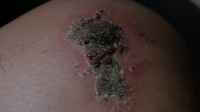 A very close up shot of a scab on a knee