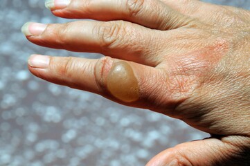 Large blister on womans hand caused by boiling water scald.