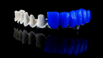 dental beam made of quality titanium and half of artificial teeth made of blue wax for fitting, shot on a black background