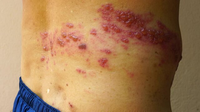 Skin lesion symptom in Shingles or Herpes zoster in human. Shingles or Herpes zoster is aviral disease caused by varicella zoster virus charatrized by a painful skin rash with blisters on the body.