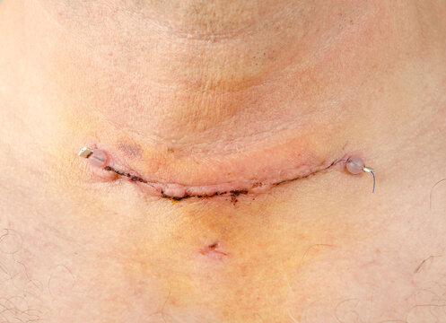 post operative scar wound and stitch of thyroidectomy also showing where drain was inserted