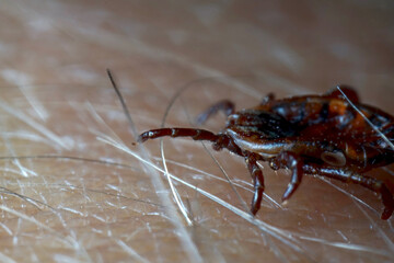 Macro close up of crawling parasitic Dermacentor reticulatus crawling on human skin. Also known as the ornate cow tick, ornate dog tick, meadow tick, and marsh tick. 