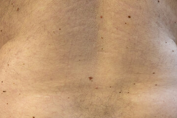 men's back in moles, doctor's examination photo