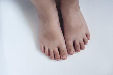 Children's feet on a light background. The problem of nail fungus in children. Abnormal growth of nails