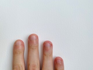 Bitten and Ritten fingernails with copy space