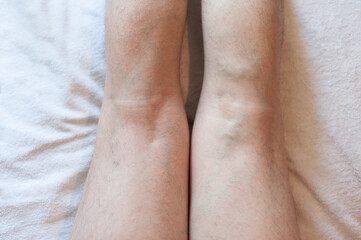 Legs of a man with varicose veins on a light background