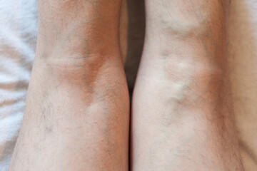 Fototapeta premium Legs of a man with varicose veins on a light background