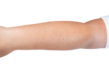 The arms with brown spots on the skin need good care for the skin