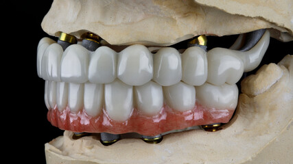 temporary dental dentures in the bite on a special dental model, shot from the side on a black background