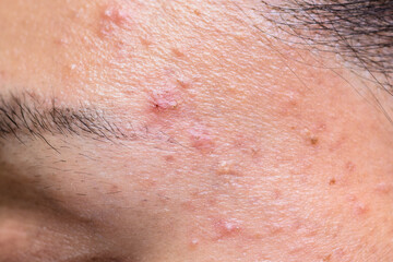 Fototapeta premium Young Asian woman showing her face with acne and moles