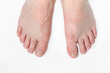 Nail fungus on the toes of male feet. Onychomycosis