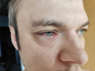 Close the upper left eyelid abscess. Man eye with barley. Barley diseases, the concept of disease development. inflammation. stye