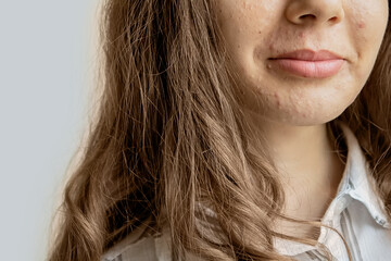 Adolescent girl suffering in acne. Dermatological disease acne