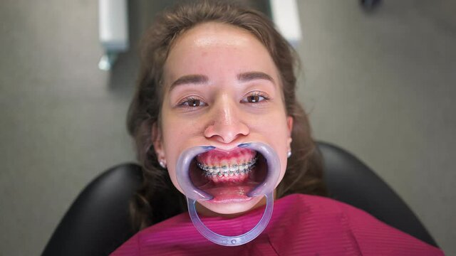 Young Woman Patient with Retractor in Mouth with Braces in Dental Office Lies in Hospital Bed and Waits for Dentist. Healthcare and Medicine Concept. Close up. Portrait
