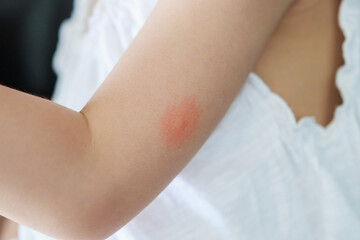 Little girl has skin rash and allergy from mosquito bite