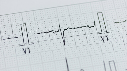 心臓の検査で記録された心電図の波形